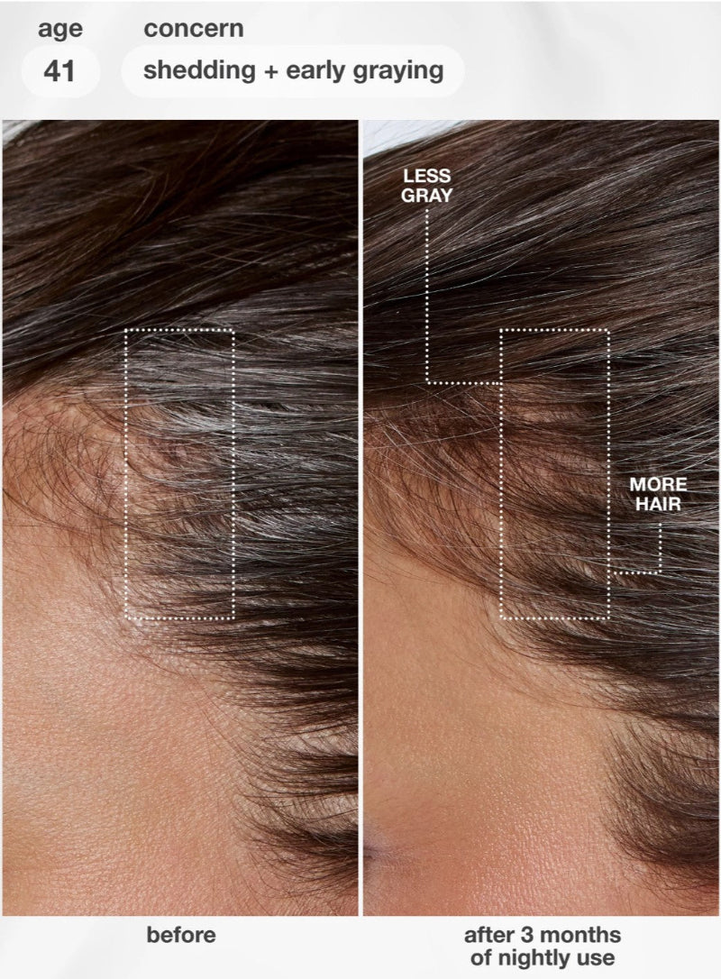 Before-and-after comparison of a person's hair at the crownline, showing early gray hair shedding on the left and fuller, darker hair on the right, with text labels 'before', 'after 3 months of nightly use', 'age 41', and 'shedding + early graying'. The model is using a K18 hair serum