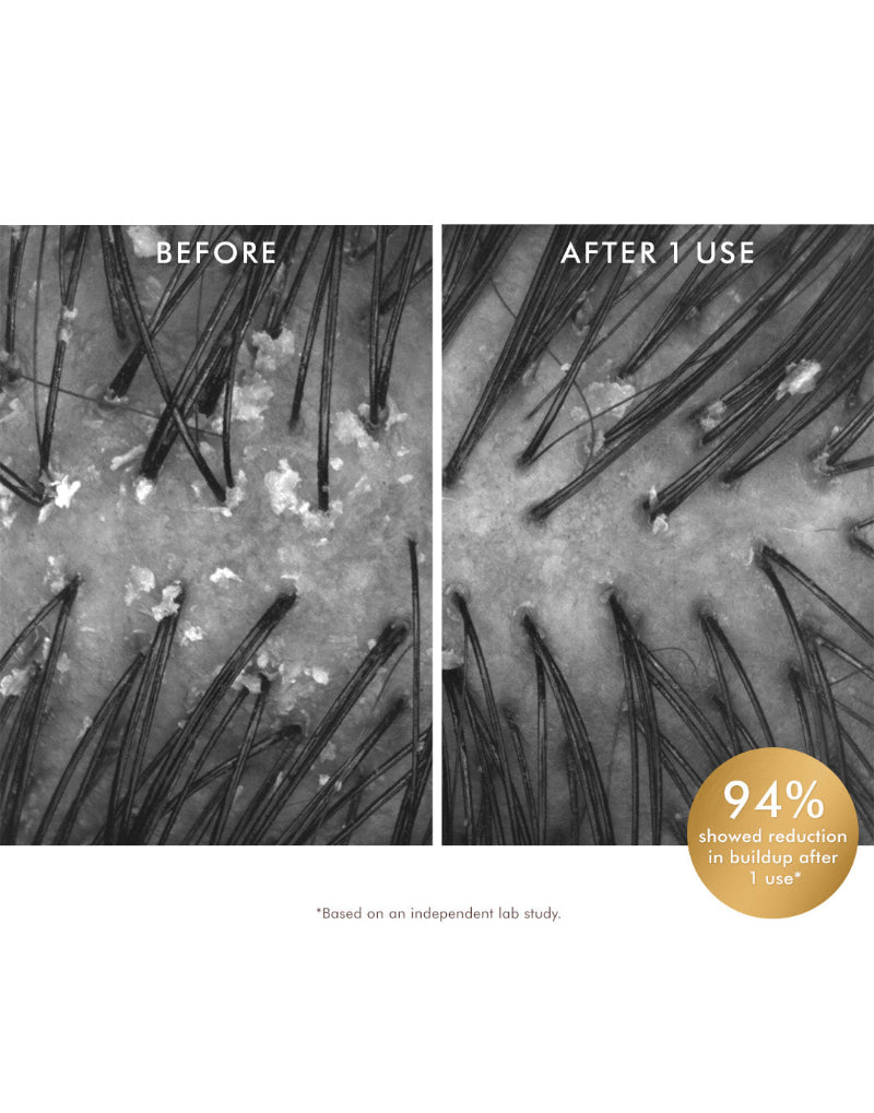 Before and after comparison of hair follicles with a product application, showing 94% reduction in buildup. The model was using Moroccanoil exfoliating pre-shampoo scalp treatment