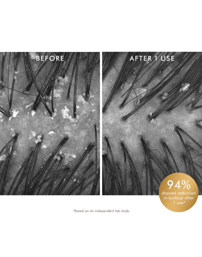 Before and after comparison of hair follicles with a product application, showing 94% reduction in buildup. The model was using Moroccanoil exfoliating pre-shampoo scalp treatment